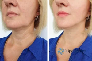 Double chin before and after Hi-Fu treatment 4 Book your double chin treatment Market Harborough today! We are here to help!