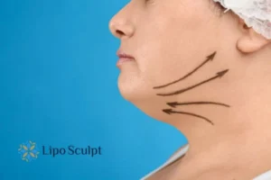 Double chin before and after Hi-Fu treatment 3 Boost your confidence with a Double chin treatment Market Harborough