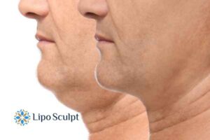 Double chin before and after Hi-Fu treatment 2 Double chin treatment Market Harborough from Lipo Sculpt - feel more confident today!