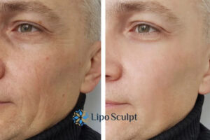 How to Fight Aging Symptoms 3 Fight Aging Symptoms Market Harborough With HIFU and Morpheus8 Today!