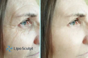 How to Fight Aging Symptoms 2 Do you want to Fight Aging Symptoms Market Harborough? Contact Lipo Sculpt today!