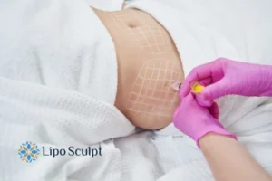 Are The Results From Aqualyx Permanent? 1 Do you want to know how long Aqualyx Market Harborough results last?
