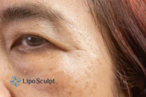 Cryopen: The Revolutionary Treatment for Age Spots Unveiled 2 Are age spots Market Harborough giving you low self esteem? Contact us today!