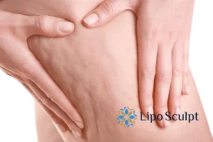 CoolSculpting for Legs: The Innovative Approach to Redefining Your Legs 5 Start your journey today book your coolsculpting treatment Market Harborough online today!