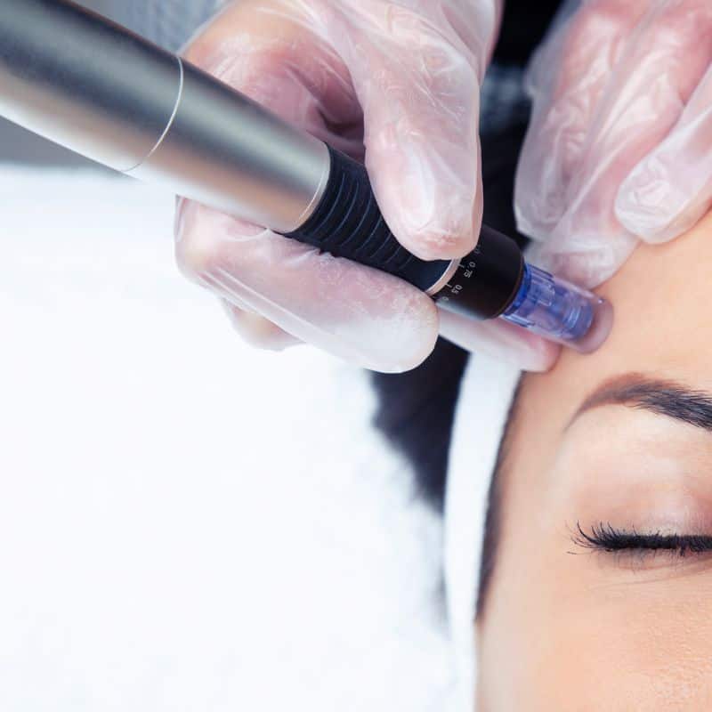 Morpheus8 treatment Market Harborough from Lipo Sculpt - Book in today!