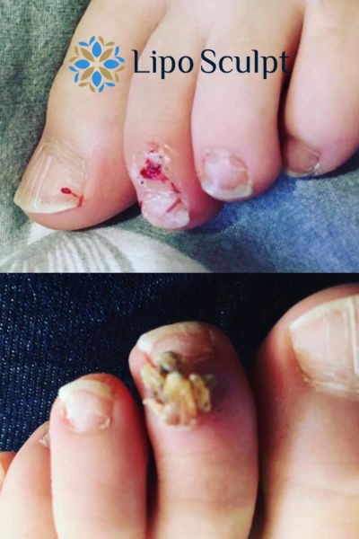 Wart removal customer results from Lipo Sculpt Market Harborough